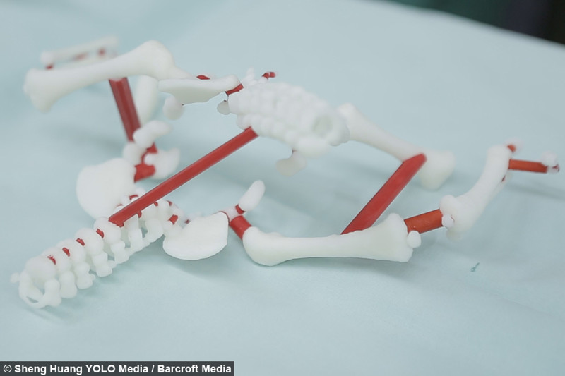 Успешная операция по разделению сиамских близнецов с применением технологий 3D-печати