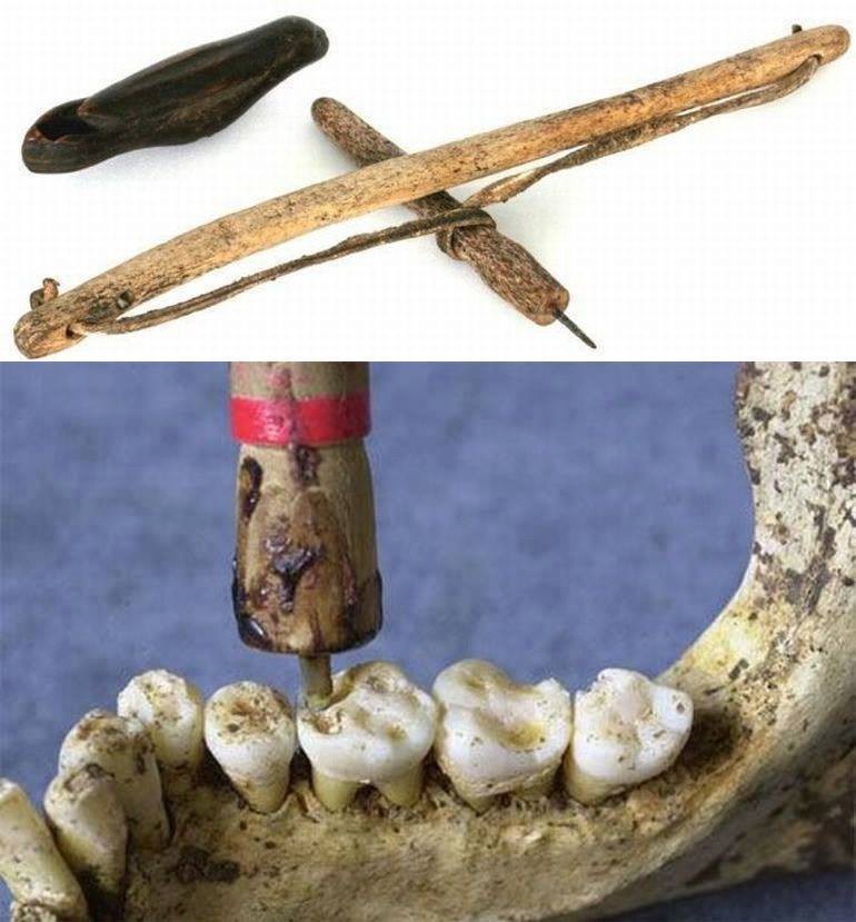 Старинный метод для лечения зубов thumbnail