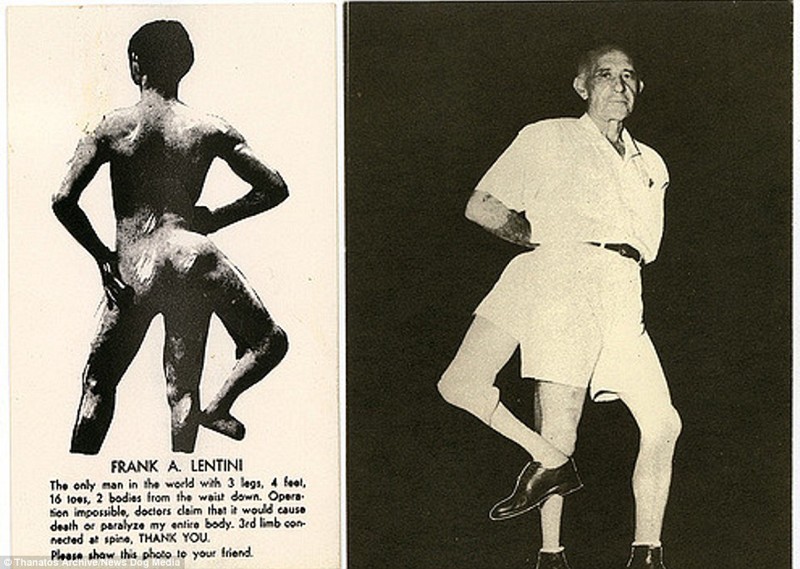 Фрэнк Лентини, который родился с тремя ногами, стал знаменит в США. Его называли не иначе как «Король». Гвоздем его выступления было набивание футбольного мяча третьей ногой