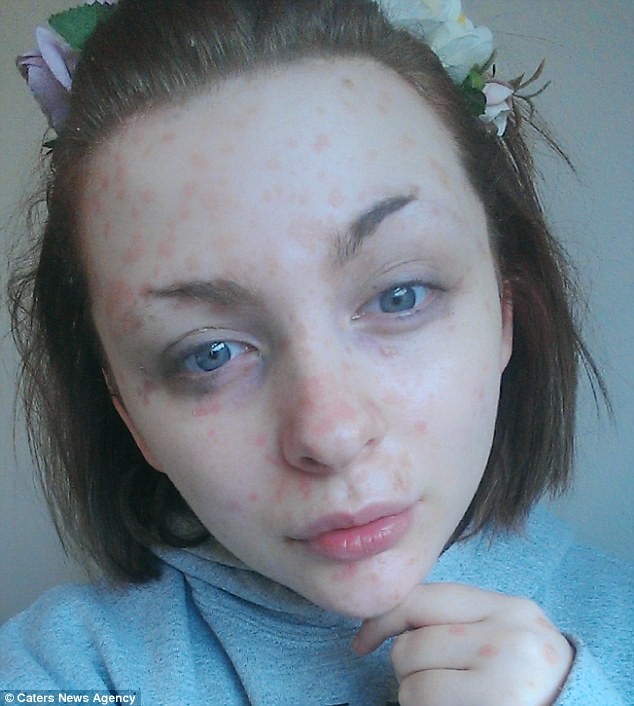  Чудеса макияжа: девушка с «кожей-чешуей» вдохновляет больных псориазом волшебными преображениями