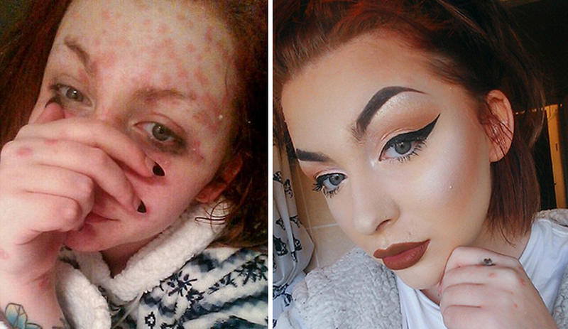  Чудеса макияжа: девушка с «кожей-чешуей» вдохновляет больных псориазом волшебными преображениями