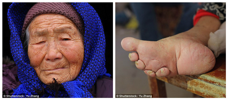 Эта 95-летняя старушка  - представительница последнего поколения китайских женщин, уродовавших ступни ног подобным образом