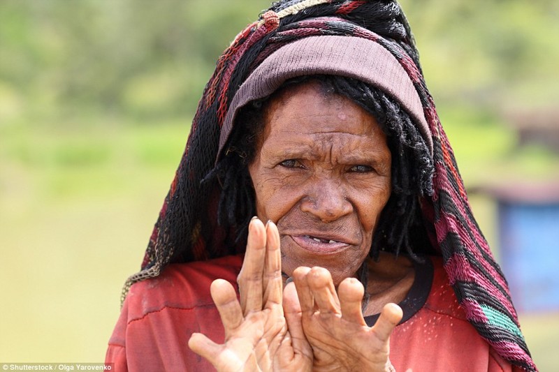 В племени Дани (провинция Папуа, Индонезия) некоторые женщины  - вроде той, что на фотографии - отрезают фаланги пальцев, когда умирает их родственник