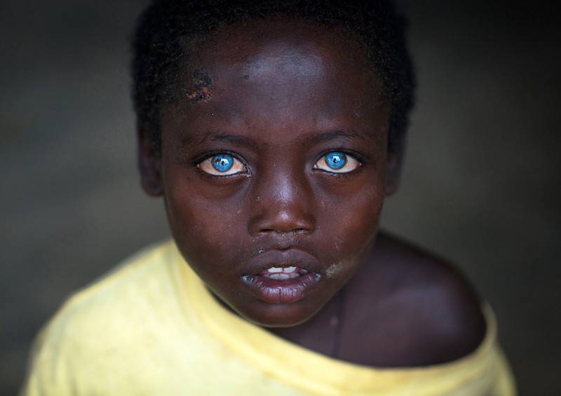 Невероятно красивые глаза африканского мальчика, подаренные ему болезнью