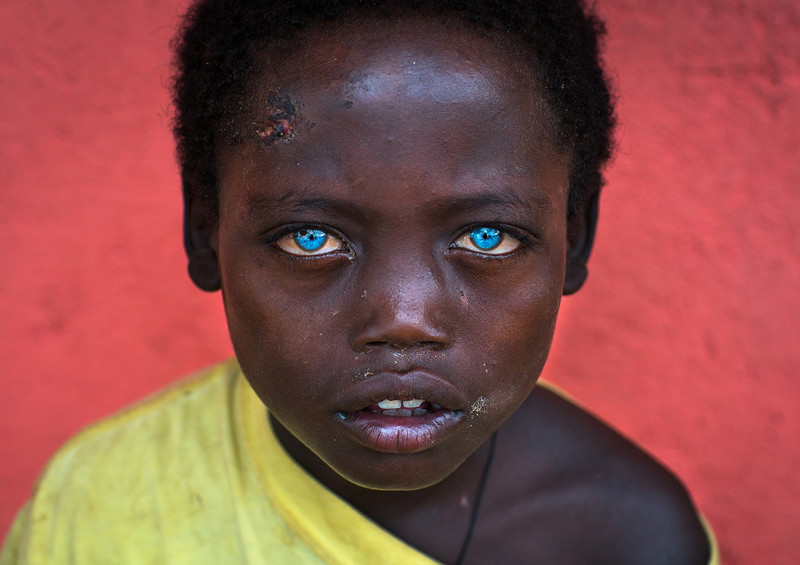 Невероятно красивые глаза африканского мальчика, подаренные ему болезнью