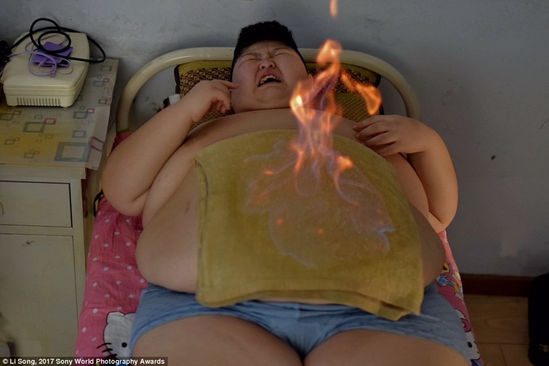 11-летний Ли Ханг, страдающий от синдрома Прадера — Вилли, проходит традиционную китайскую процедуру в центре по снижению веса