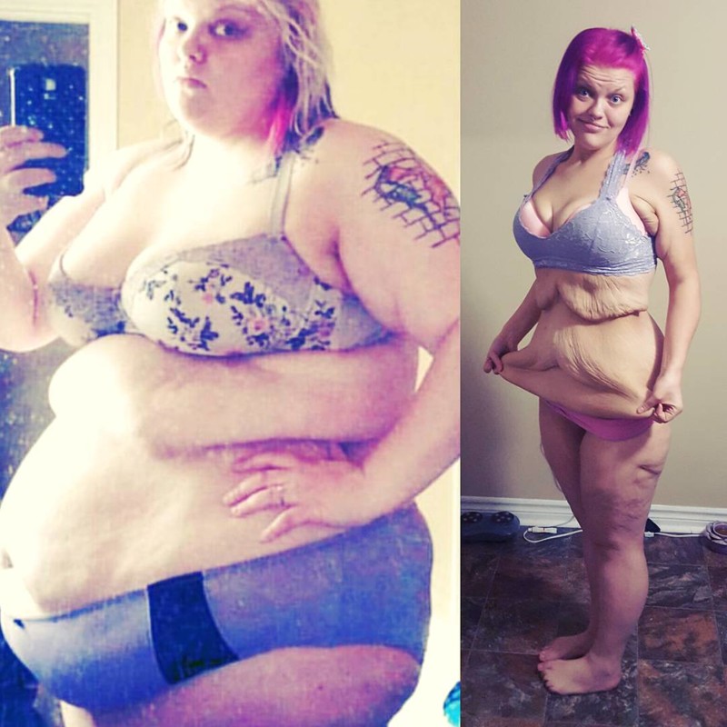 После потери 85 кг эта женщина осталась с огромным количеством лишней кожи, и она не постеснялась её показать 