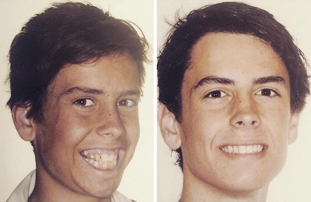 Разница между снимками - 2 года и 10 месяцев в брекетах