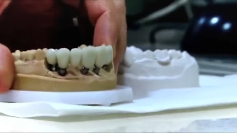 Вывод такой: удалить минимум 11 зубов и поставить импланты