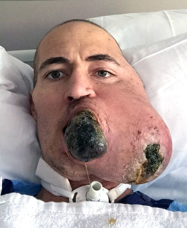 Мужчину, потерявшего лицо из-за опухоли, спас гениальный хирург