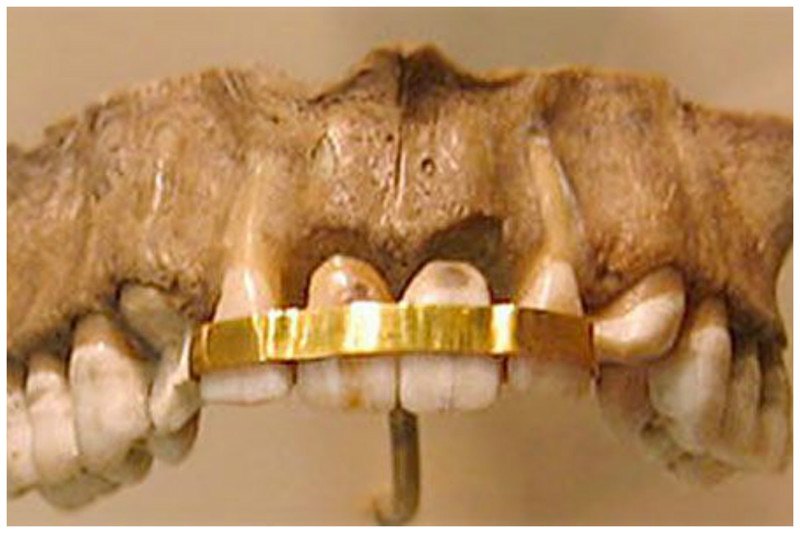 Древние египтяне заменяли зубы донорскими, используя золотую проволоку, чтобы прикрепить зубы донора к собственным зубам