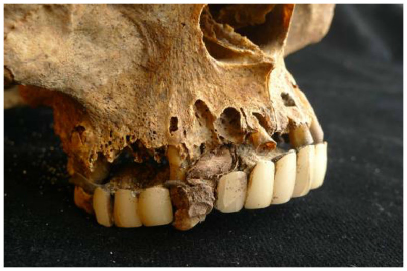 Протезирование 18 начала 19 века - вставная челюсть из фарфоровых зубов и пластиной, изготовленной из сплава меди, с небольшим количеством цинка, золота, свинца и никеля.