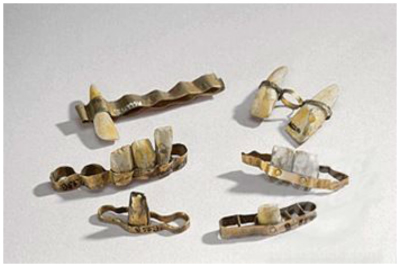 Этруски делали зубные протезы в 7 веке до н.э.