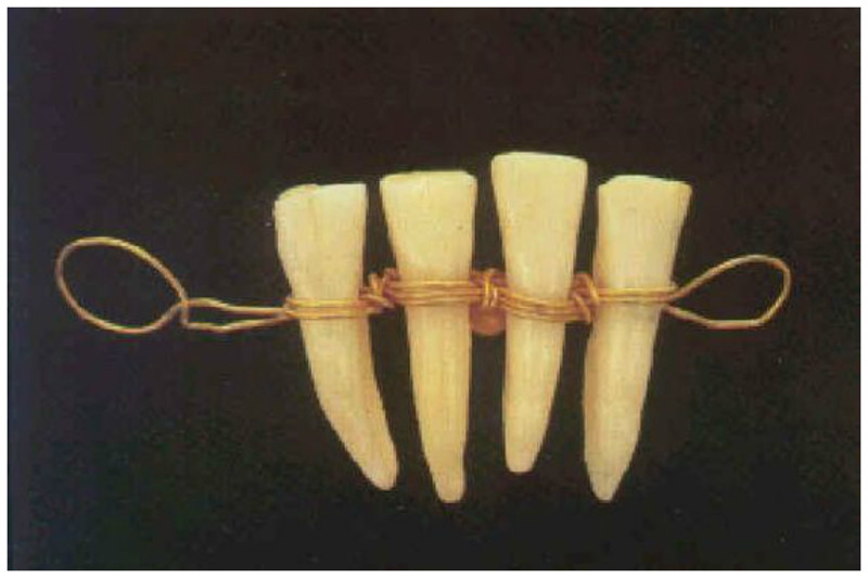 Для протезов использовались также зубы животных.  Четвертый век до н.э. - зубы животного на золотой ленте, предназначенные для протезирования