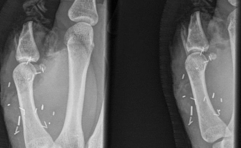 Однако затем хирурги нашли неортодоксальный выход: они убедили юношу, что пересадка большого пальца ноги вернёт его ладони утраченную фунциональность 
