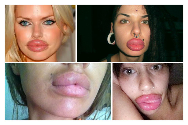 Зачем на самом деле девушки увеличивают губы?