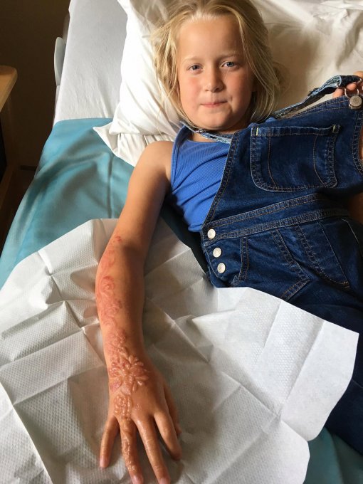 После временной тату в Египте вся рука семилетней девочки покрылась жуткими шрамами