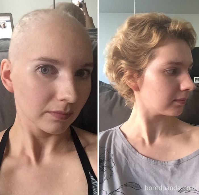 Рак желудка фото до и после