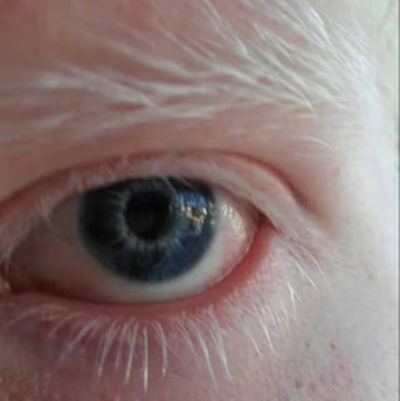 Какого цвета глаза у людей альбиносов? фотографии глаз альбиноса. Миф или правда?