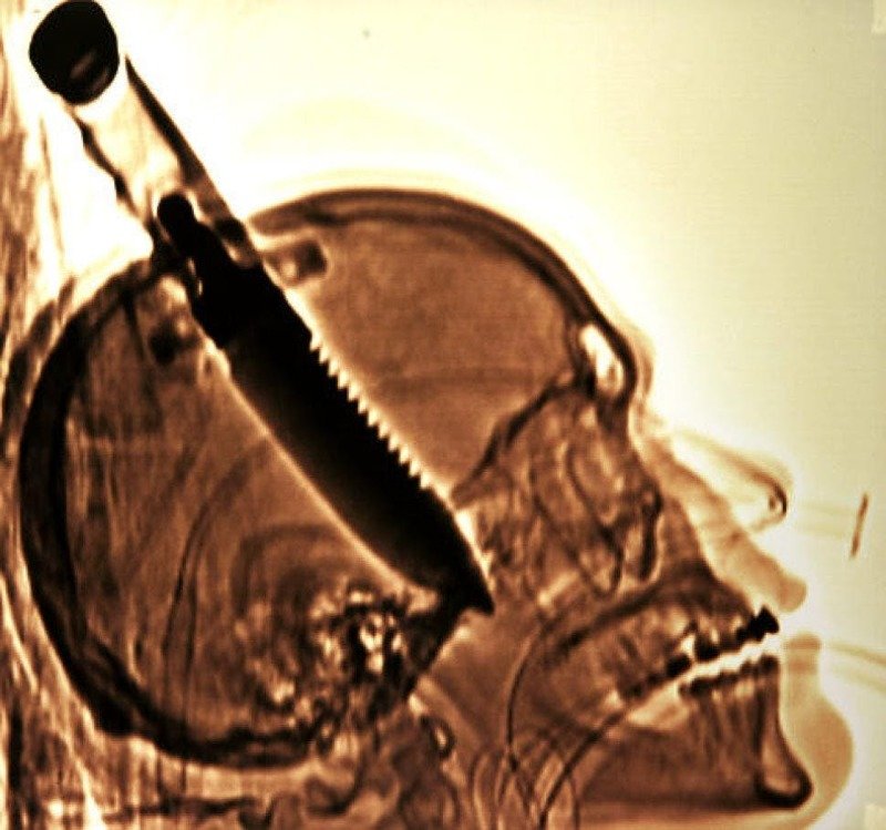 3. Самый большой объект, удаленный из черепа пациента