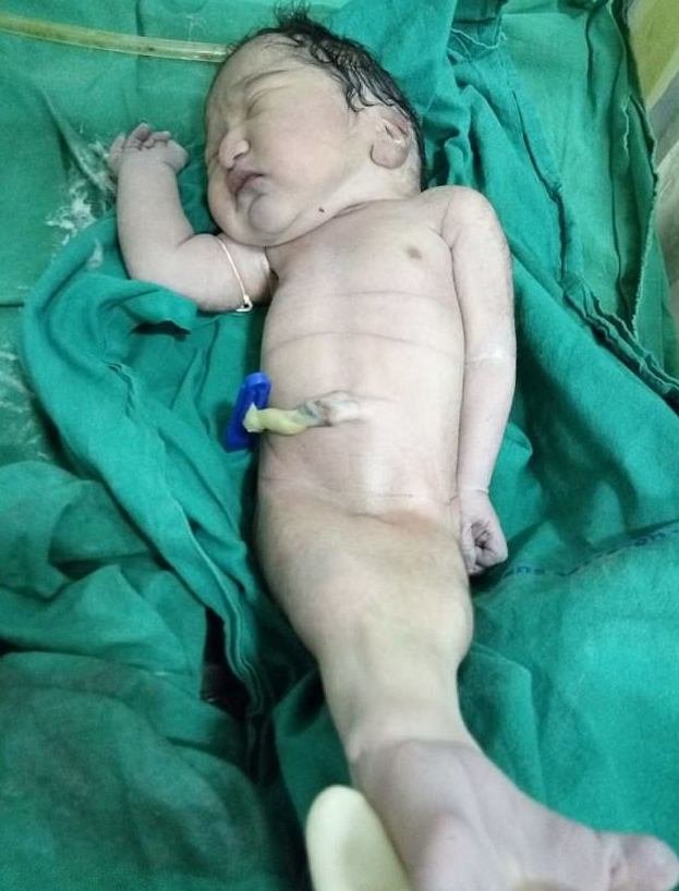Индийская "русалочка" умерла через четыре часа после рождения
