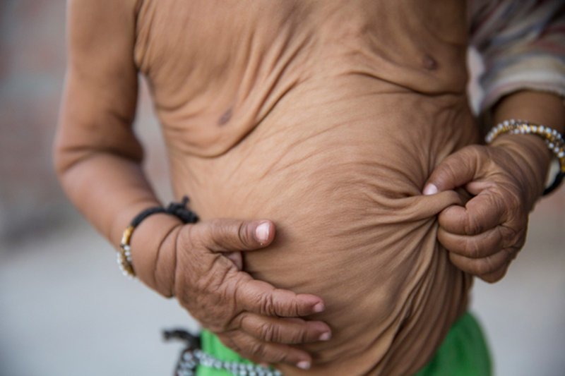 Семейная трагедия: сразу двое детей страдают от прогерии