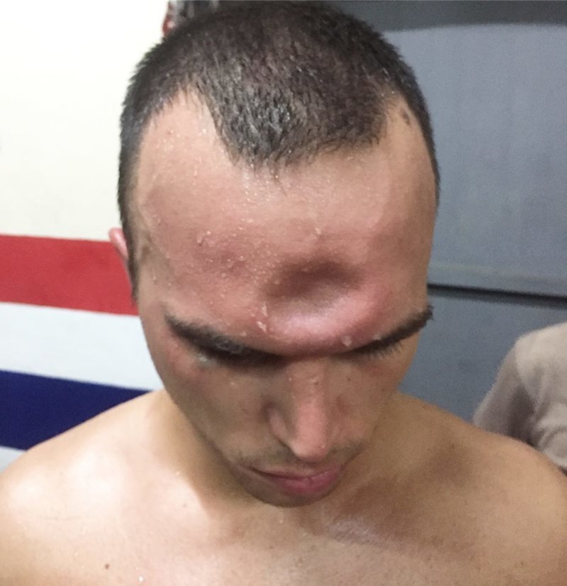 Повреждение было получено во время противостояния, которое проходило на арене Патонг. Оппонент Джереми с силой ударил локтем прямо ему в лоб