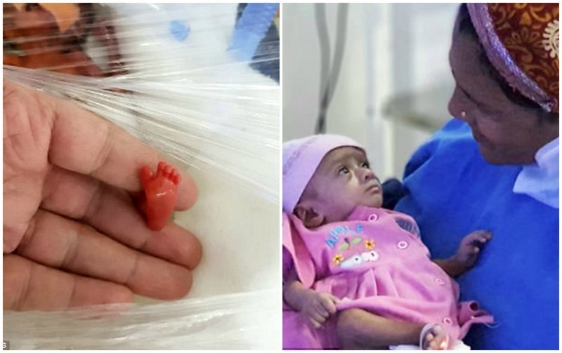 "Она боролась, и ей удалось выжить": в Индии спасли 400-граммового малыша