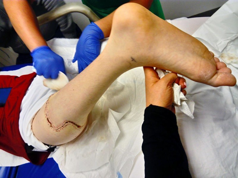 Хирурги пришили ребенку ногу задом наперед, чтобы он мог играть в футбол
