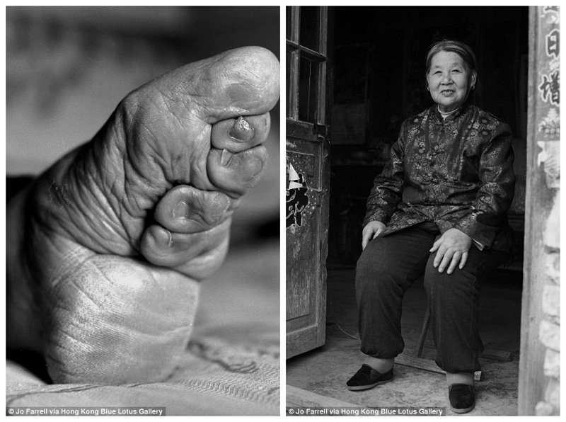 Су Кси Ронг и ее деформированная ступня
