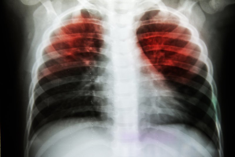 В России значительно снизилась смертность от туберкулеза