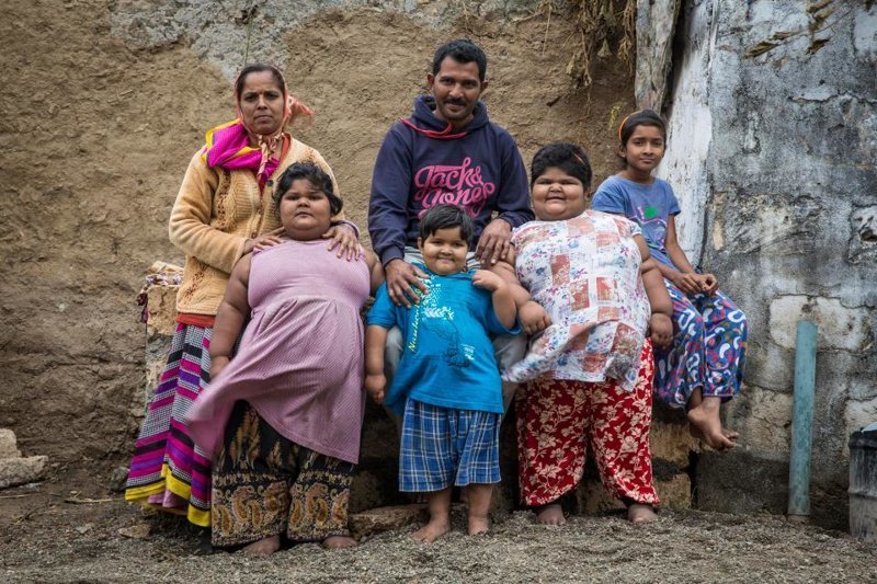 Самым толстым сестрам из Индии уменьшили желудки и они начали худеть