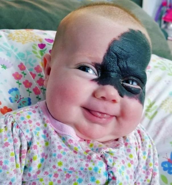 Малышка родилась с огромным пятном на лице, но родители не спешат его удалять!  