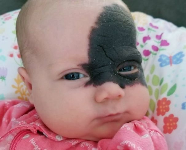 Малышка родилась с огромным пятном на лице, но родители не спешат его удалять!  