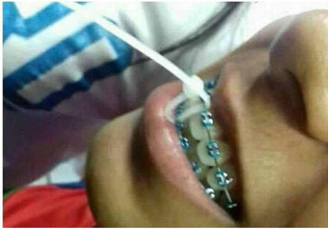 Ничто так не помогает сохранять тишину у стоматолога, как кабельная стяжка