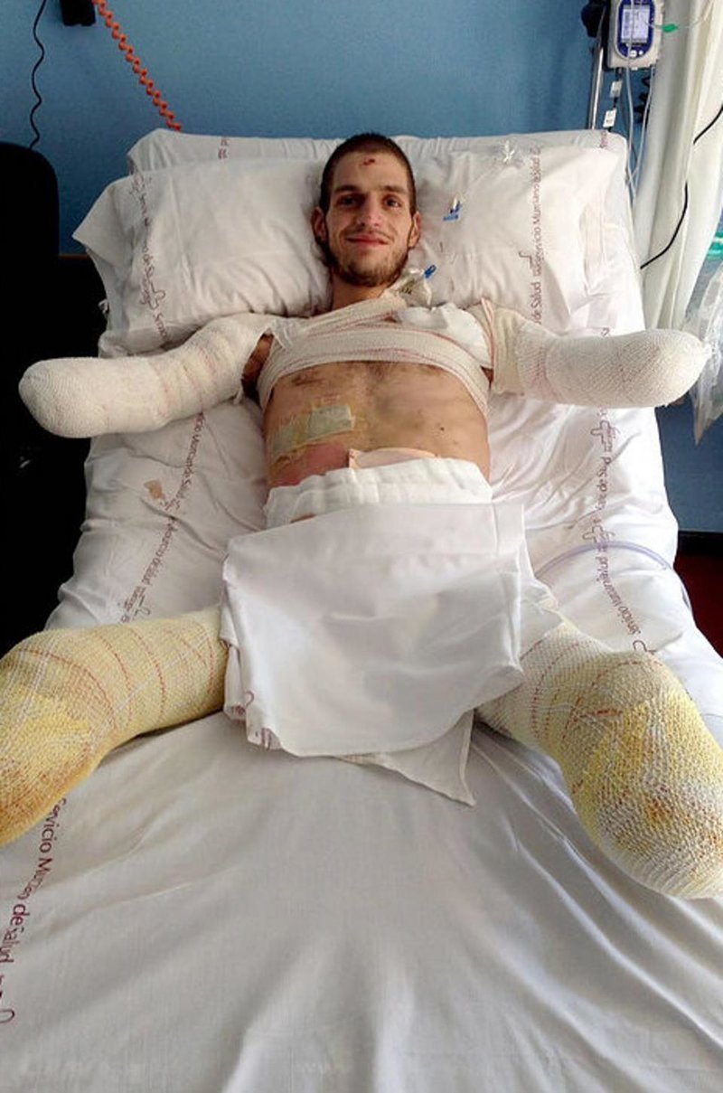 24-летнему испанцу ампутировали конечности из-за ошибки врачей