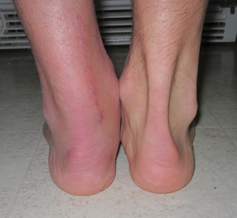 8. Примерно так выглядит нога после разрыва ахиллова сухожилия