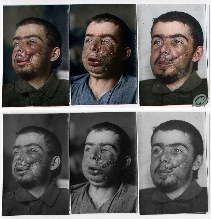 Реконструкция лица солдата после ранения во время Первой мировой войны