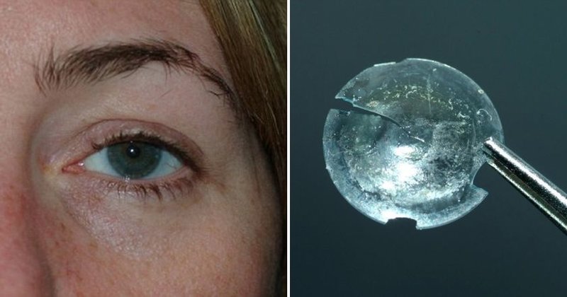 Из века женщины достали контактную линзу, которая пробыла там почти 30 лет