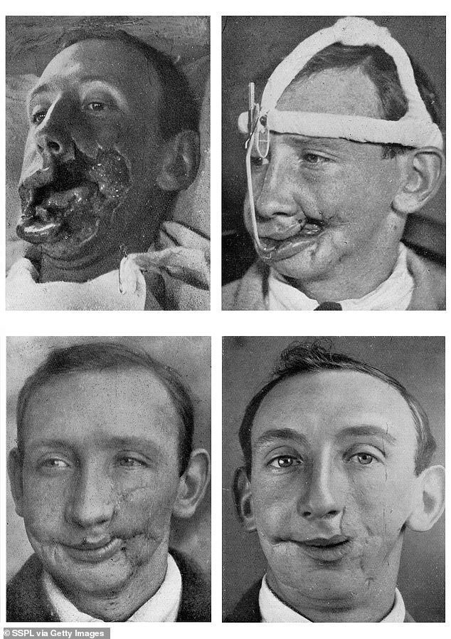 Снимки солдат до и после реконструкции лица по методам Гиллиса