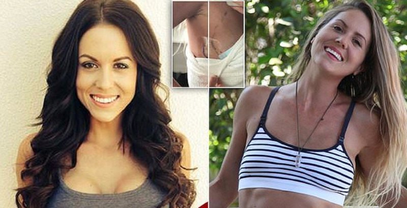 31-летняя австралийка обрела радость жизни, избавившись от грудных имплантов