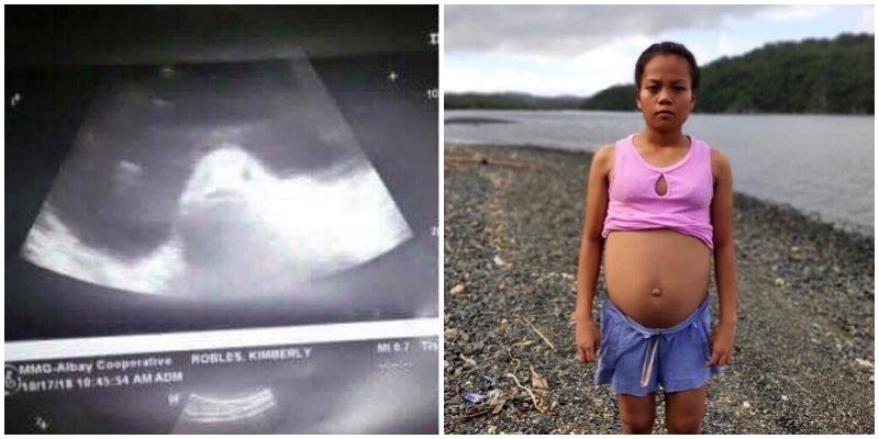 Жители Филиппинской провинции Албай верят, что 17-летняя девушка беременна рыбой