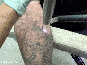 Удаление татуировок