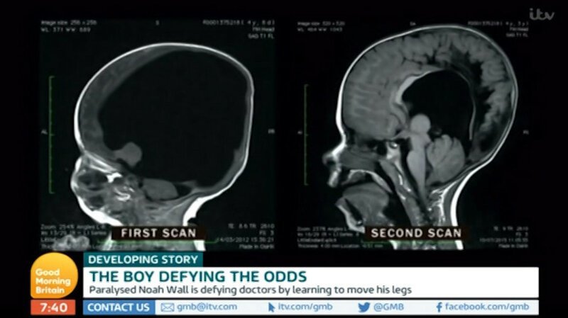 Мальчик, родившийся без мозга, опроверг прогнозы врачей