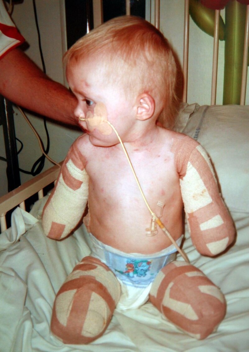 В младенчестве девочка переболела менингитом, который и привел к ампутации рук и ног