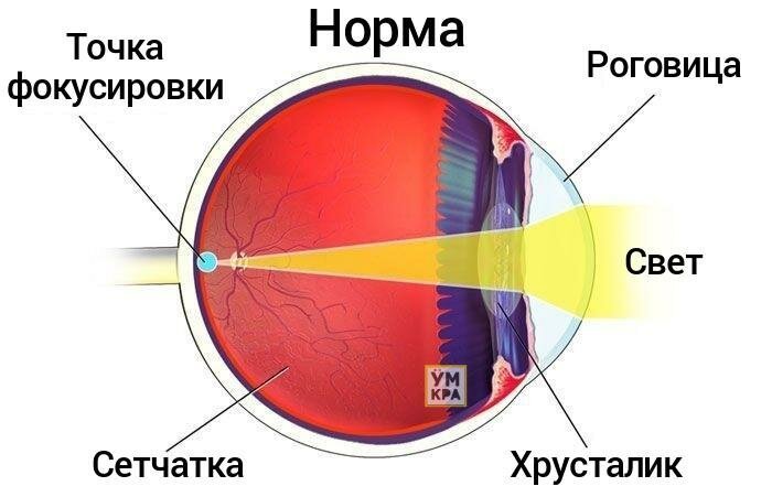 Астигматизм глаза человека картинки thumbnail