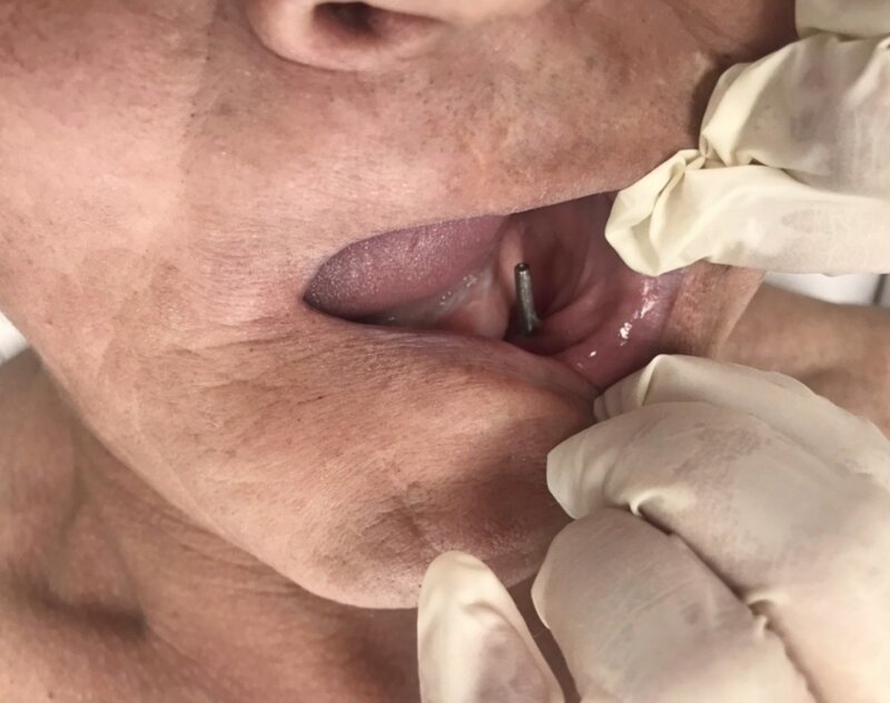 В Бурятии мужчина прожил 27 лет с болтами вместо зубов