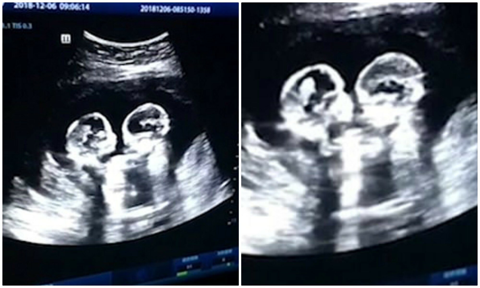 12 неделя 24 года. УЗИ на 3 месяце беременности двойней. УЗИ 12 недель беременности двойня однояйцевые.