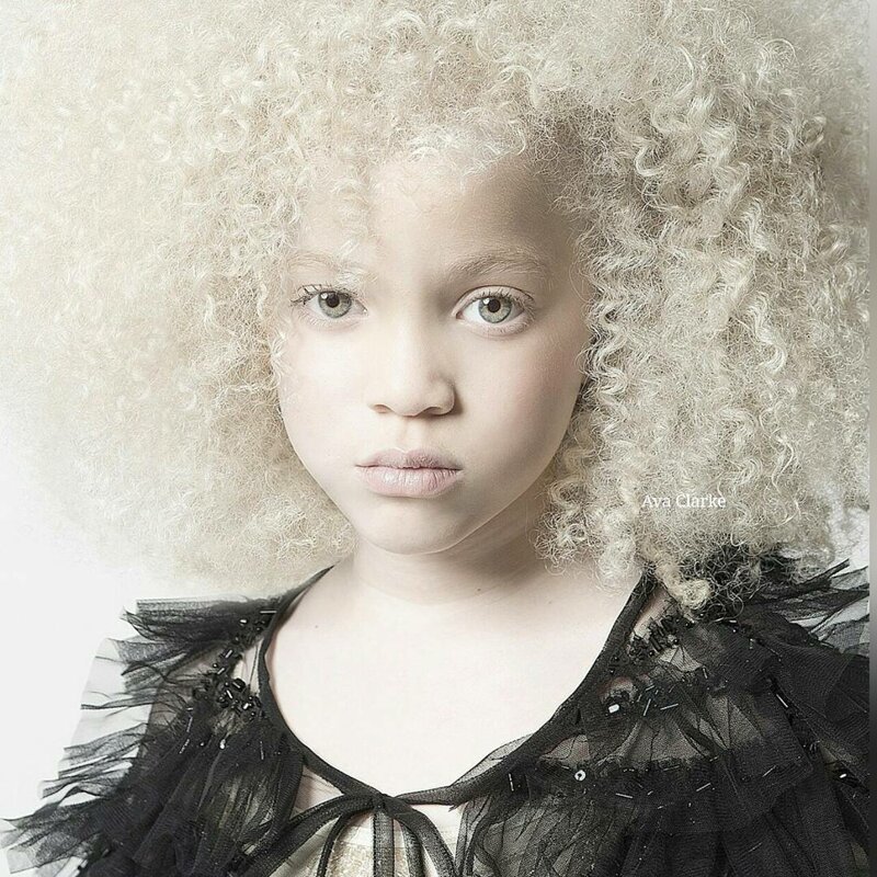 17. Афроамериканка-альбинос