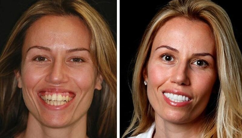 Винир на кривой зуб фото до и после